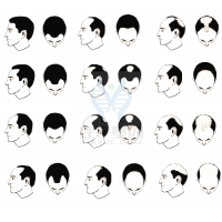 【佳學(xué)基因檢測】過早<font color='red'>脫發(fā)</font>、掉發(fā)太多怎么辦？你的方法可能是錯的！