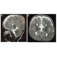 <b>【佳學基因檢測】唐奈-巴羅綜合征基因檢測（DBS)及其治療</b>