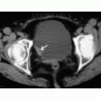 <b>【佳學基因檢測】膀胱癌基因檢測的依據、實施及靶向藥物治療</b>