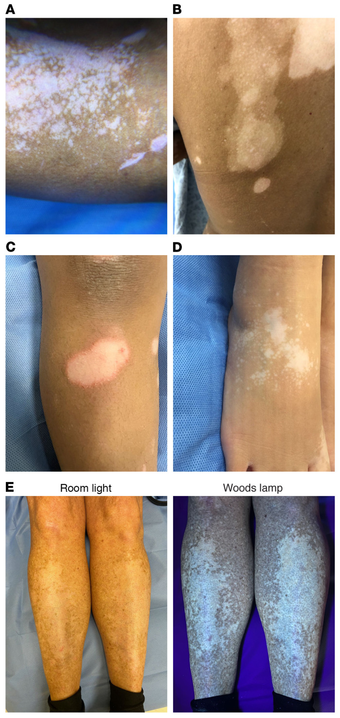 圖2：白癜風(fēng)的活化區(qū)域